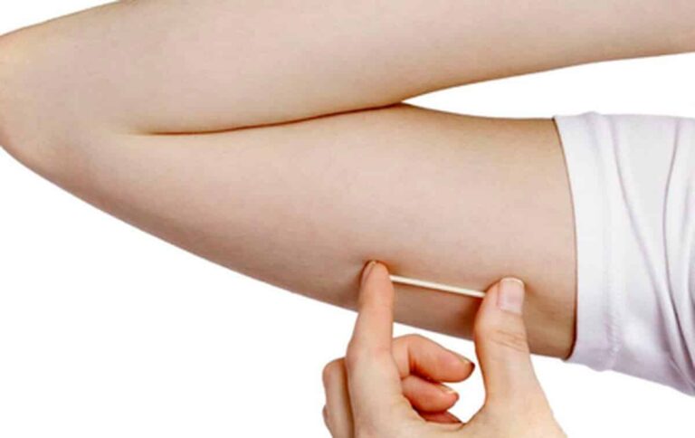 implante_contraceptivo
